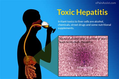 does having hepatitis make passing a drug test hard|Drugs and Chemicals That Cause Toxic Liver Disease .